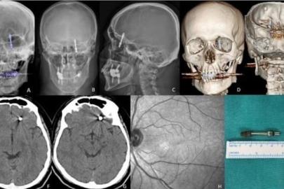 Beynine saplanan implant hayatını kararttı: 2 yıldır adalet bekliyor