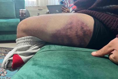 Vicdanları yaralayan olay: Otizmli şahıs odunluğa baktı diye odunla darbedildi