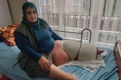 Fil hastalığı bacağını 100 kilo yaptı, tedavisinin devamı için destek bekliyor