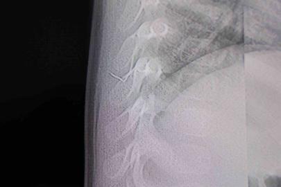 Bebeğin sırtından tel parçası çıktı