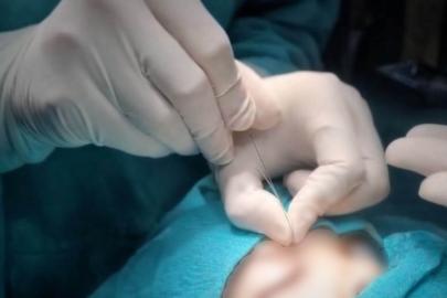 Çukurca’da gözyaşı kanalı ameliyatları yapılmaya başlandı