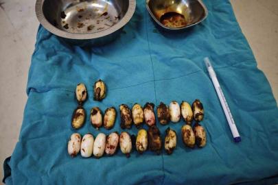 Midesinde taşıdığı uyuşturucu maddeler polisin dikkatinden sayesinde ele geçirildi