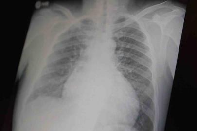 Profesör açıkladı: "Metamfetamin ve kokain gençler arasında tehlikeli boyutlara ulaştı"