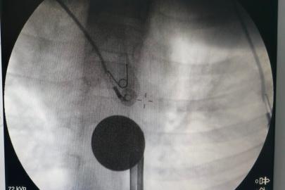 Siirt’te boğazına madeni para kaçan çocuk, doktorların müdahalesi ile kurtarıldı