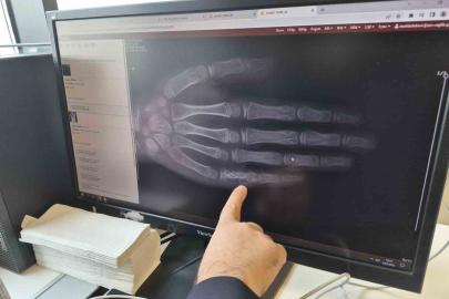 Eskişehir’de her ay 5 ila 7 çocuğa kanser tanısı konuluyor