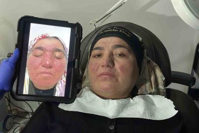 Hastalığı yüzünden yıllarca evden çıkamadı, şimdi ise çekinmeden çıkabiliyor