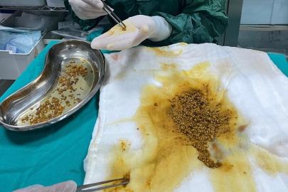 Bingöl’de nadir vaka: Safra kesesinden 2 bin 67 taş çıkarıldı