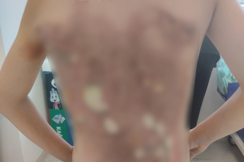 Arnavutköy’de akran zorbalığı iddiası: 12 yaşındaki çocuğun sırtını kolonya ile yaktılar