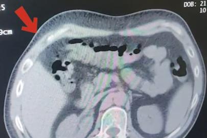Mide ve bağırsaklarından 608 gram metamfetamin çıktı